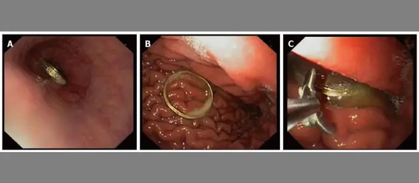 Foreign Body Removal Image