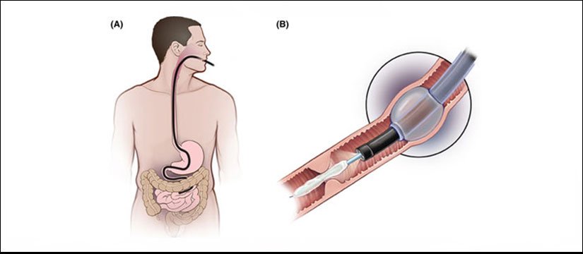 Stricture Dilatation