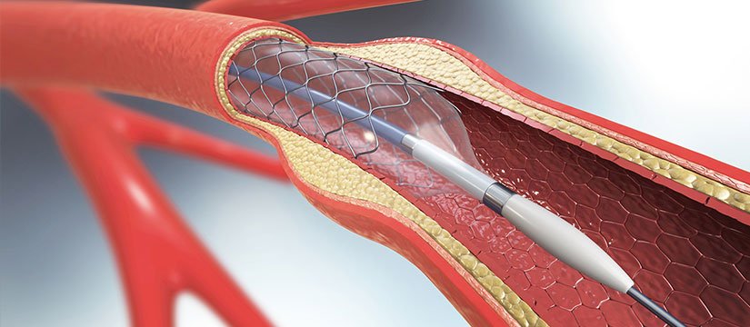 Endoscopic Stent Placement