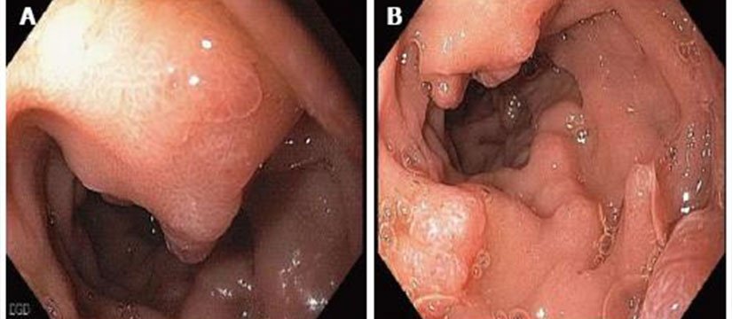 Therapeutic Endoscopy for Portal Hypertension