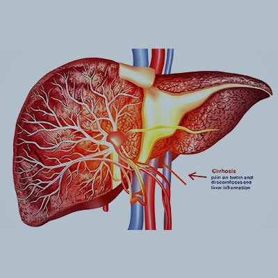 Cirrhosis