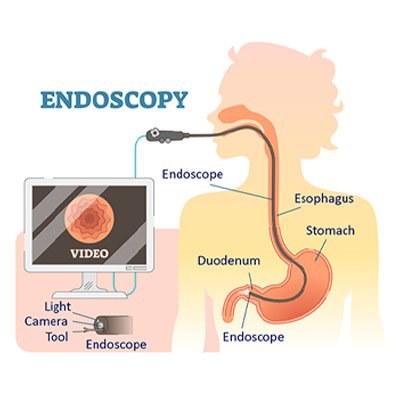 Endoscopic Biopsy