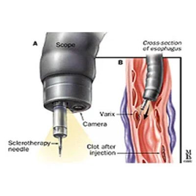 Endoscopic Variceal Band Ligation